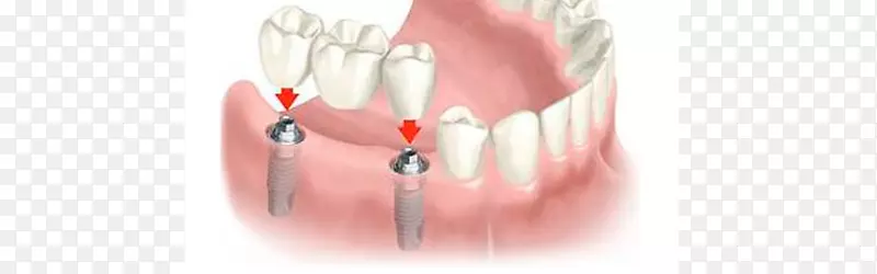 牙科种植牙桥义齿.桥