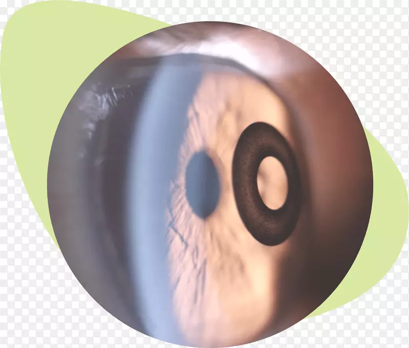 卡姆拉植入物角膜嵌体LASIK老视眼