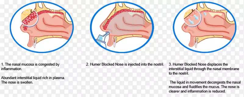鼻塞鼻粘膜鼻炎鼻