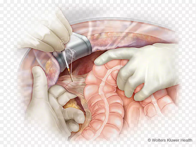 结肠弯曲，升结肠，肝性韧带，结肠切除术，肠系膜