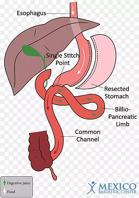 十二指肠开关胃旁路手术袖状胃切除术减肥手术-手术