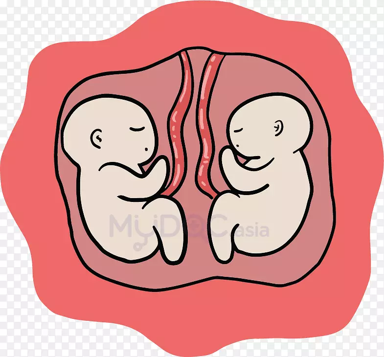 剖腹产母双胎妊娠-妊娠