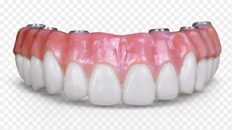 牙科种植冠义齿桥牙科.牙科技术
