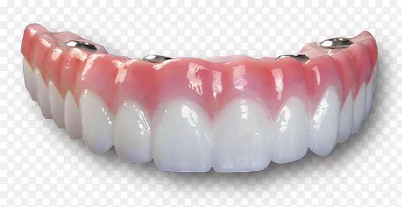 牙种植桥义齿-牙科全对4-牙科种植体