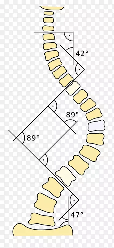 Cobb角三维治疗脊柱后凸畸形的物理治疗方法&脊柱后凸病-脊柱侧凸