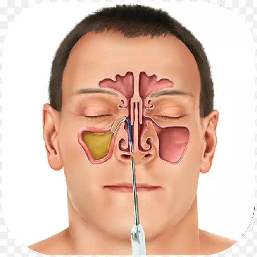 鼻窦感染副鼻窦治疗牙痛-健康