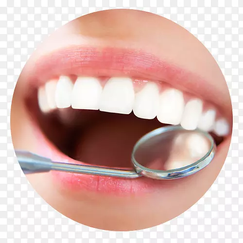 牙科洁面和根刨种植牙清洁.健康