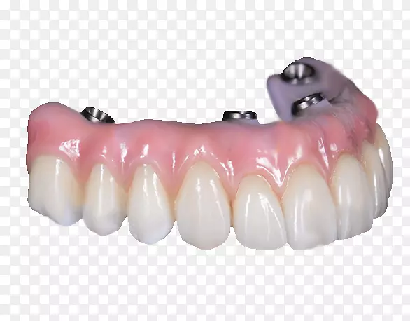 牙全对4义齿桥牙种植体桥