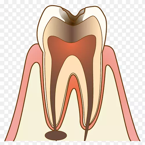 歯科牙医蛀牙疗法医院-龋齿