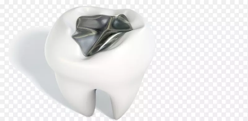 牙汞合金银牙科金属龋齿