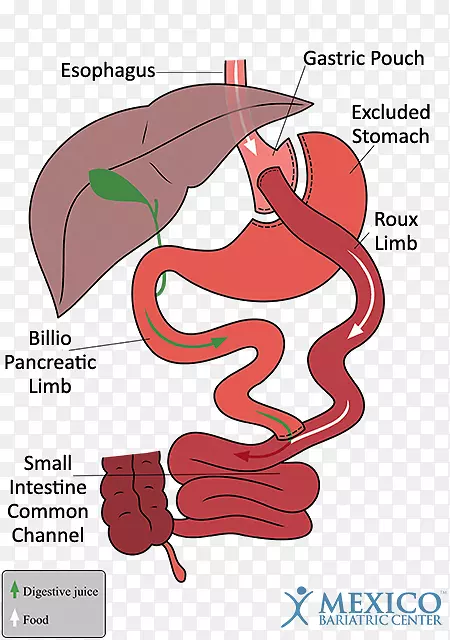 胃旁路手术减肥手术袖状胃切除术胃球囊-小肠