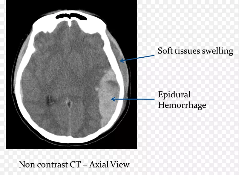 脑硬膜外血肿-脑出血的计算机断层扫描