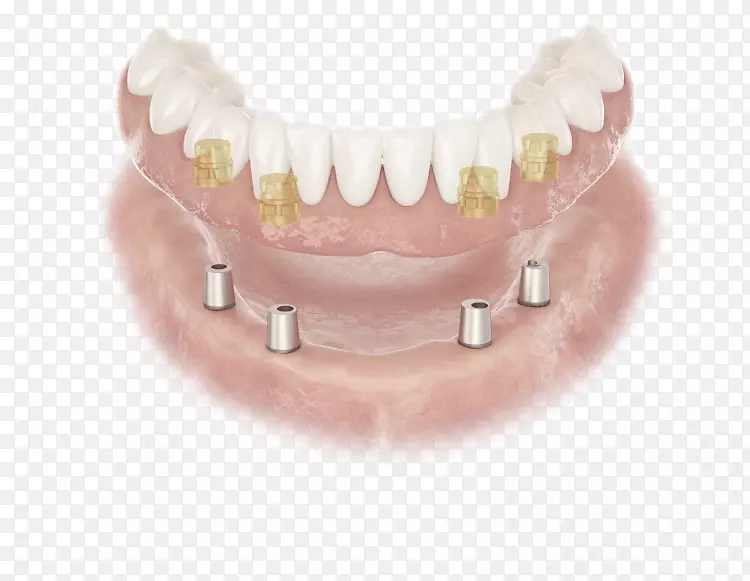 基牙义齿、牙种植体、牙医牙列学