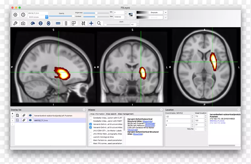 脑CT神经成像-脑