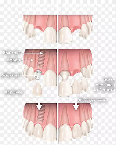 牙齿美容牙科植入物磨牙