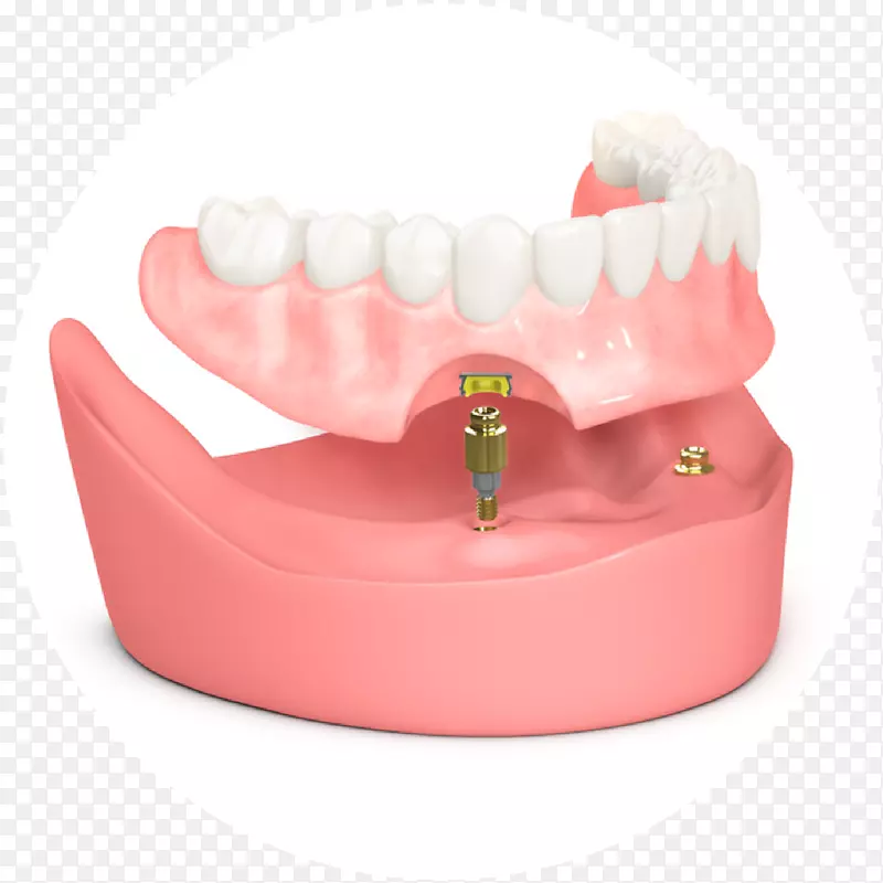 牙种植体，牙科义齿，假体