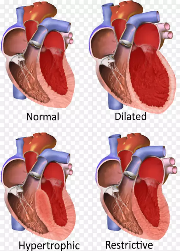 限制性心肌病扩张型心肌病肥厚型心肌病心肌-心脏