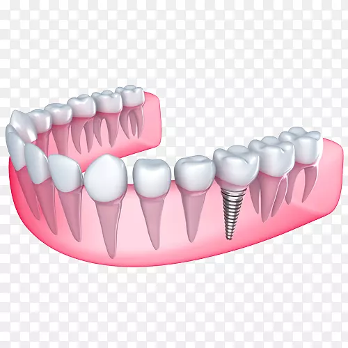 牙科种植体美容牙科义齿.健康