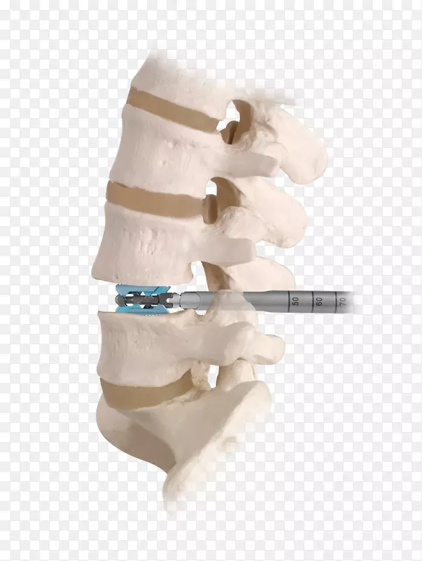 脊柱融合术椎管减压