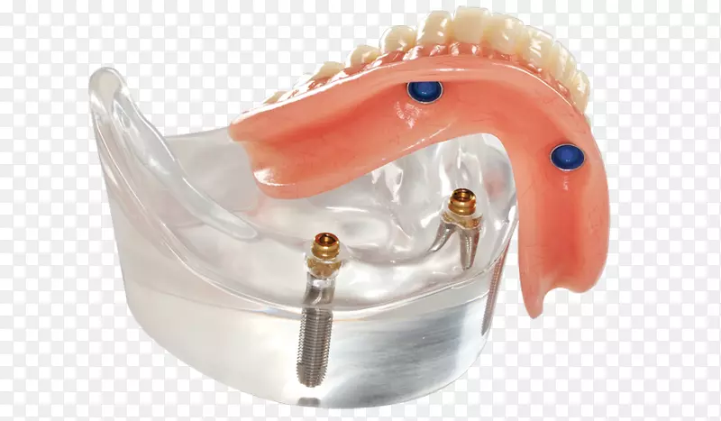 全4桥义齿种植牙可摘局部义齿