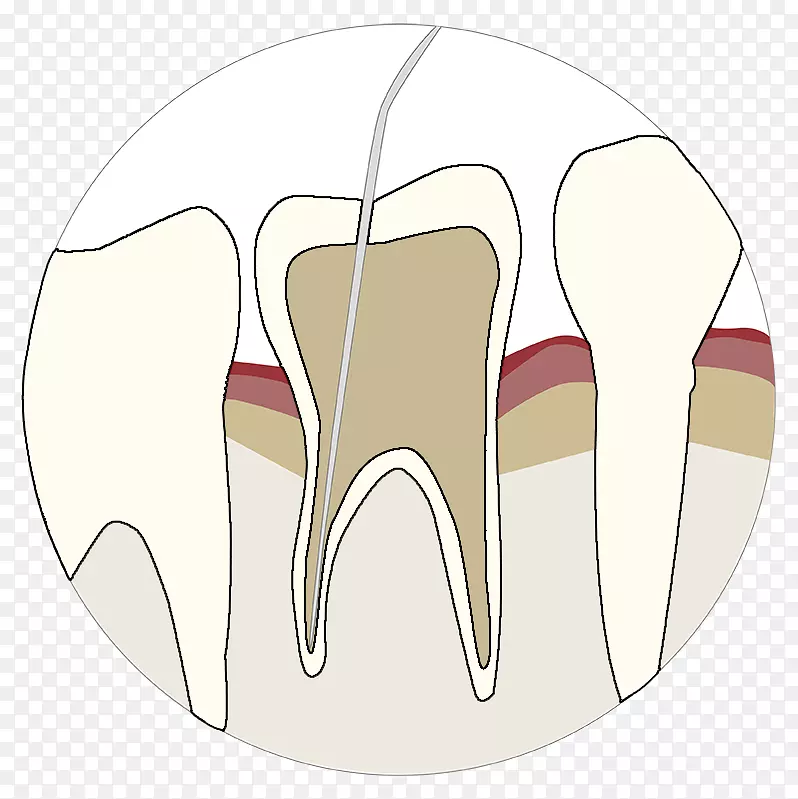 国际牙周病空气抛光牙髓学