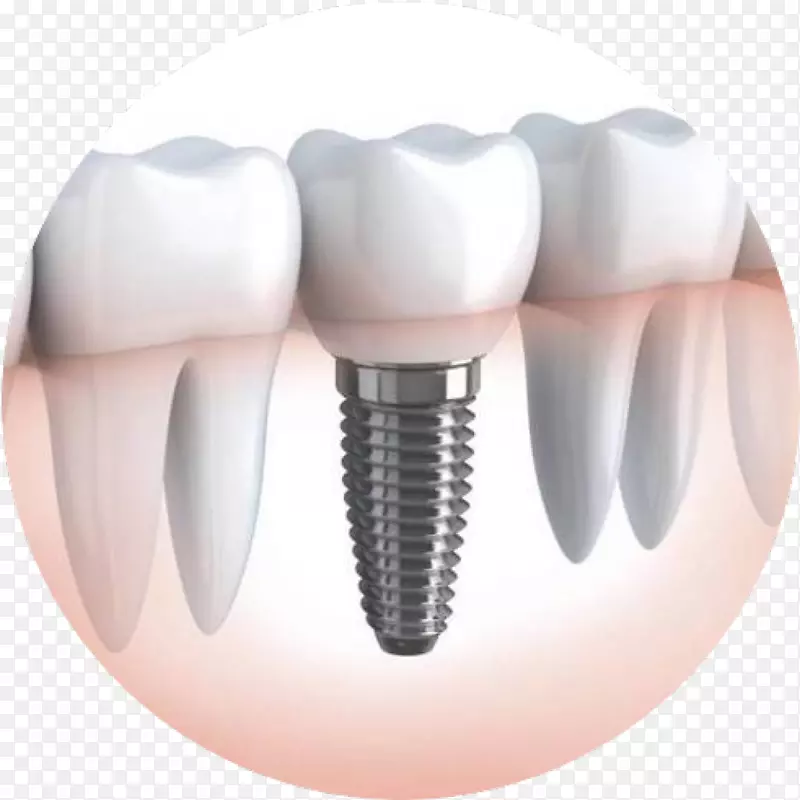 牙科种植义齿.牙冠