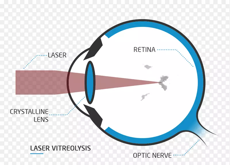 老视远视浮动视力激光治疗