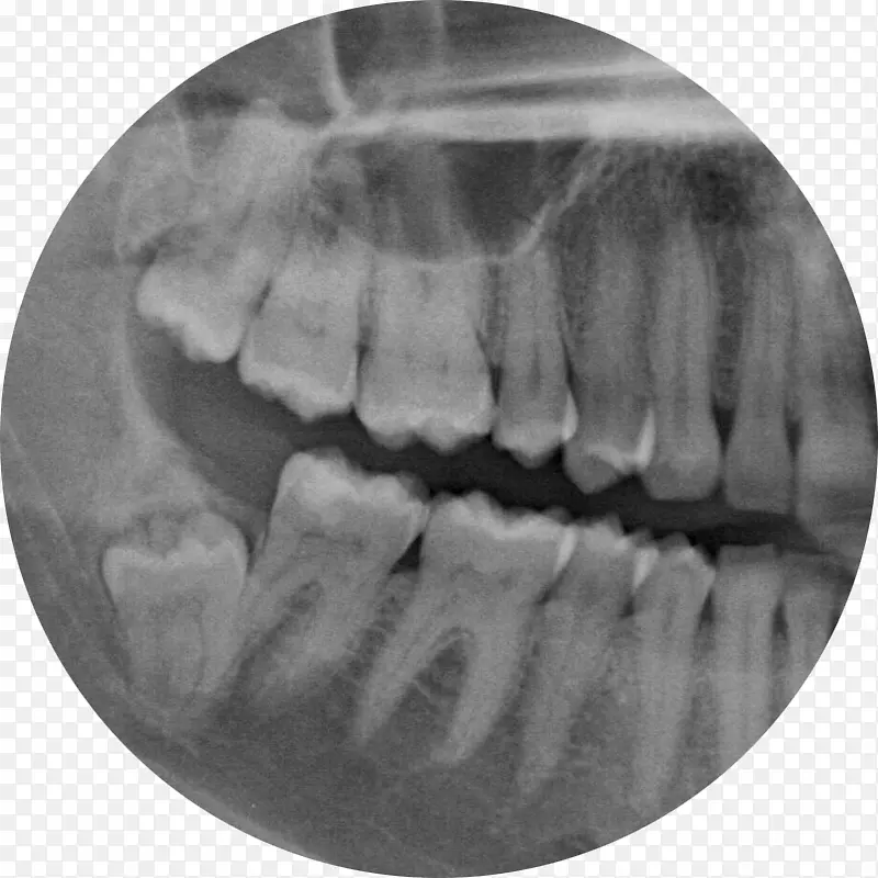 智齿拔牙下颌三叉神经牙手术