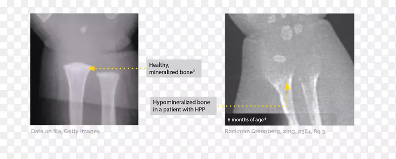 低磷症骨佝偻病骨软化放射学骨性骨折