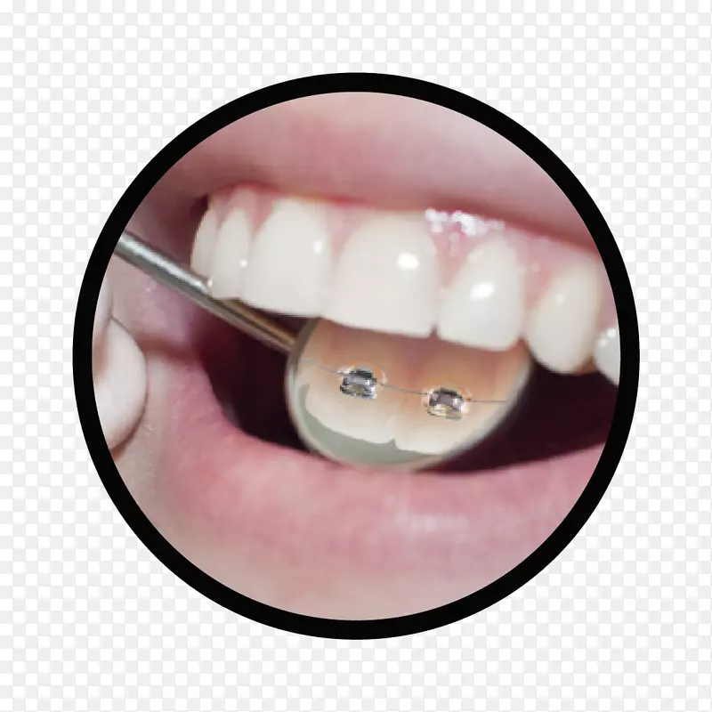 牙齿正畸清晰对齐牙科牙套.无限牙科护理