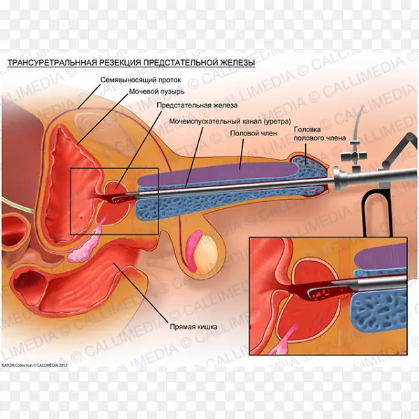 经尿道前列腺电切术-经尿道前列腺电切术
