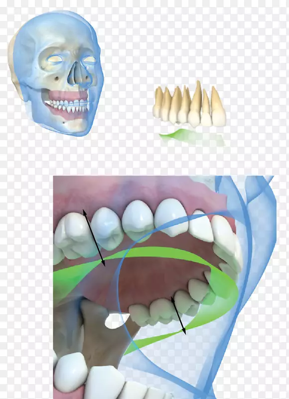 牙种植体咬合牙龈板