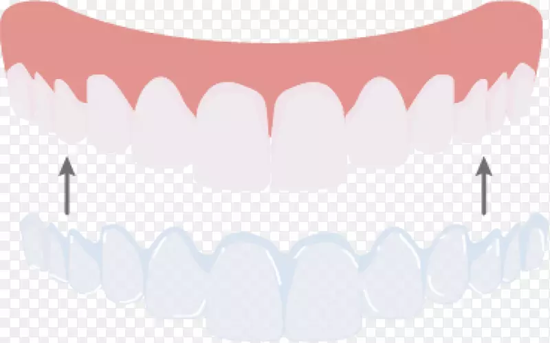 牙颌口粉红m型设计
