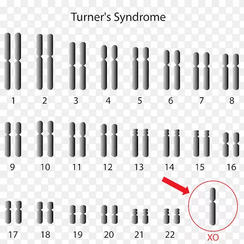 单体特纳综合征x染色体三重综合征-爱德华兹综合征