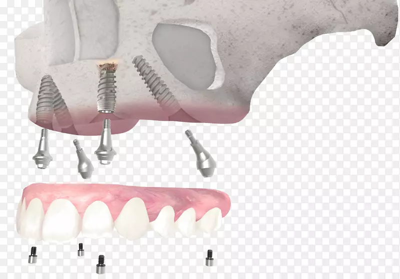 牙种植体牙科全4骨整合
