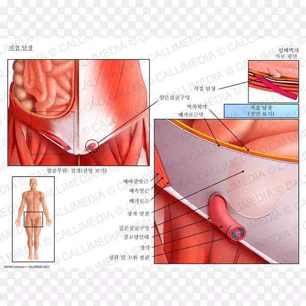 腹股沟疝腹股沟外斜肌腹股沟管解剖内疝