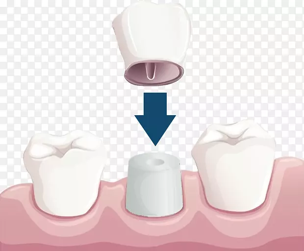 牙科修复桥冠