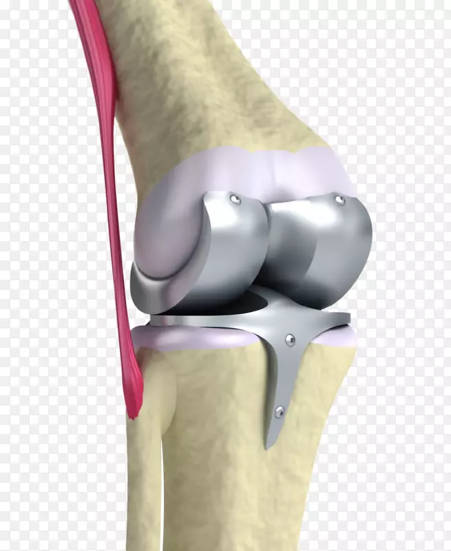 人工膝关节置换术-膝关节骨关节炎