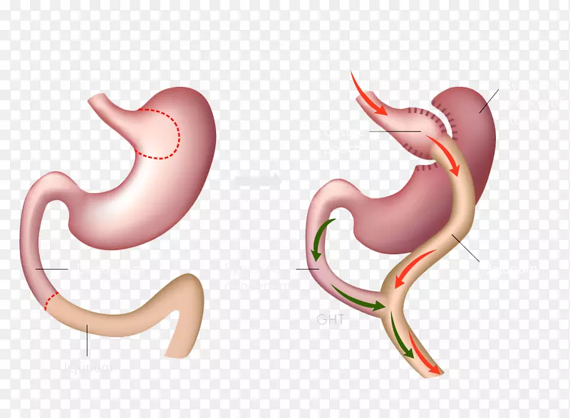 胃旁路手术减肥手术Roux-en-y吻合口袖状胃切除术-健康