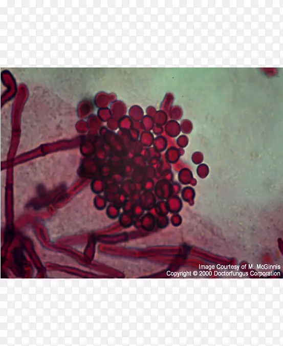 马拉色菌脂溢性皮炎病皮肤-马拉色菌