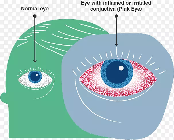 眼结膜炎感染健康医学疾病控制与预防中心