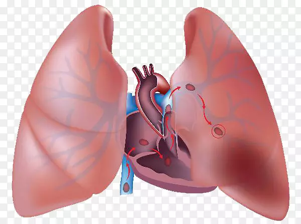 肺栓塞血栓肺动脉栓塞慢性阻塞性肺疾病