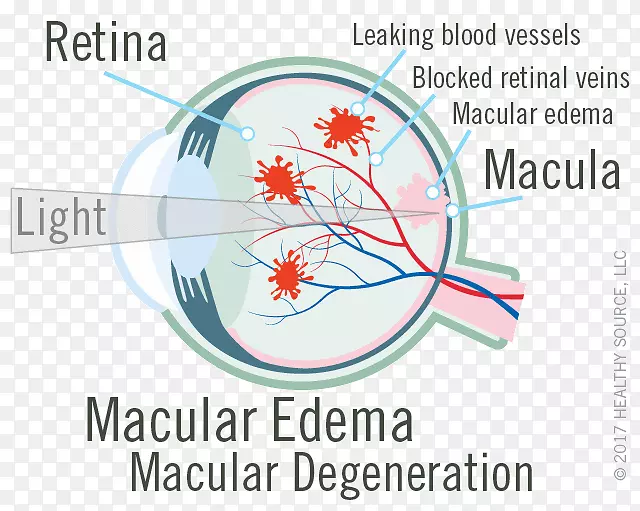 视网膜黄斑水肿黄斑部视网膜中央静脉阻塞-眼