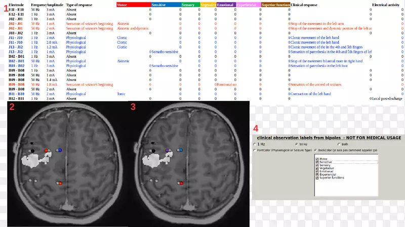 医用成像脑正电子发射断层扫描磁共振成像电极-脑