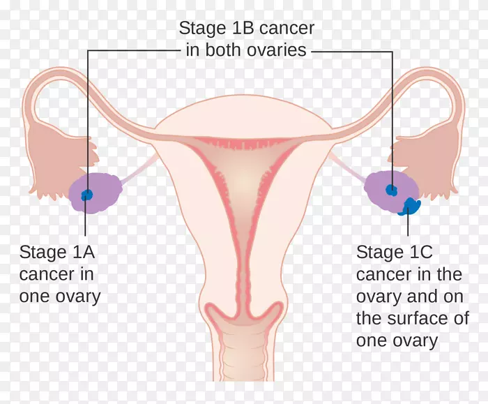 卵巢癌分期卵巢癌研究英国