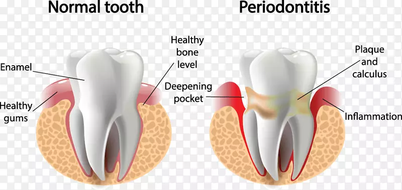 牙周病牙龈炎牙周病牙科学-健康