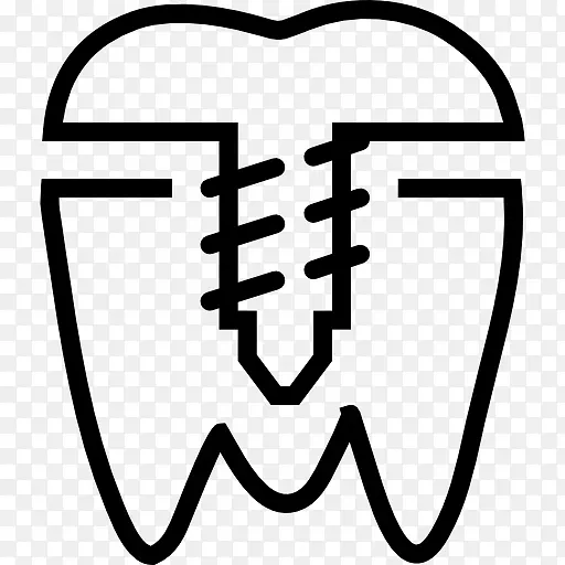 牙科种植义齿.桥