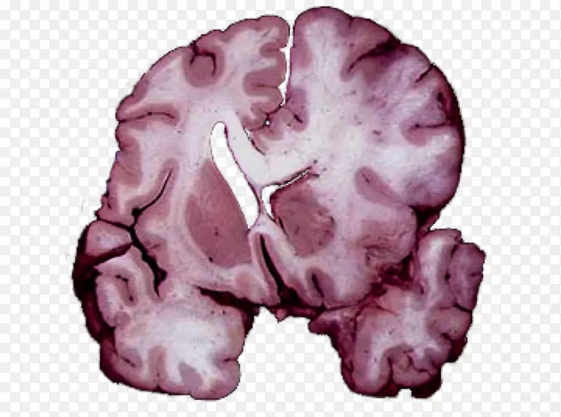 脑疝，颅内压，创伤性脑损伤，小脑扁桃体-脑