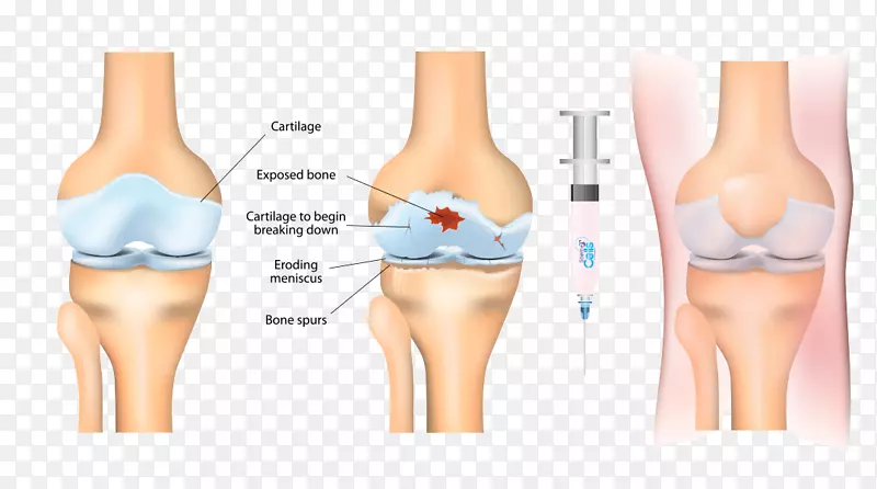 干细胞治疗骨关节炎富含血小板的血浆干细胞膝关节炎-健康