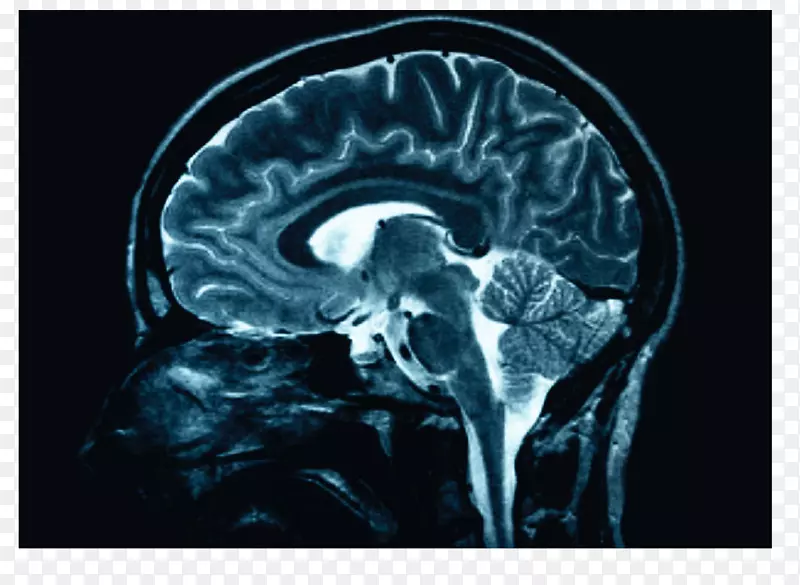 人脑x光颅脑损伤医学-脑